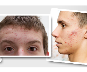 Get Free pre-market samples of acne treatments