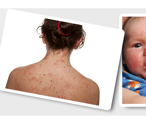 Get Free  sample of EPSOMA-XZ treatment for eczema